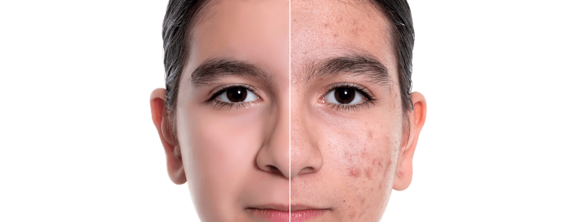 A face shown split, with clear skin on one side and skin affected by acne on the other